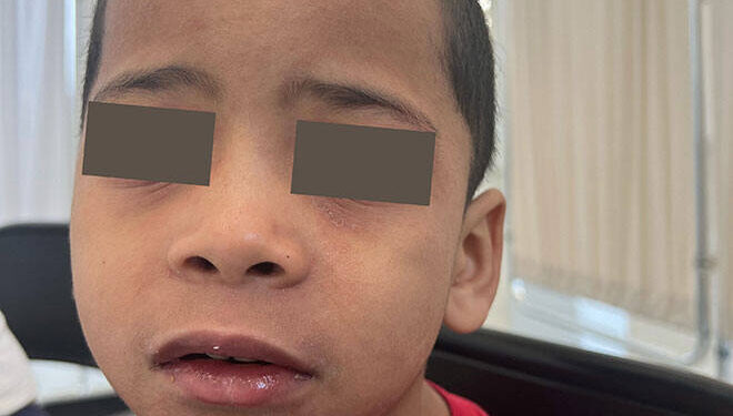 Child displaying visible symptoms associated with measles