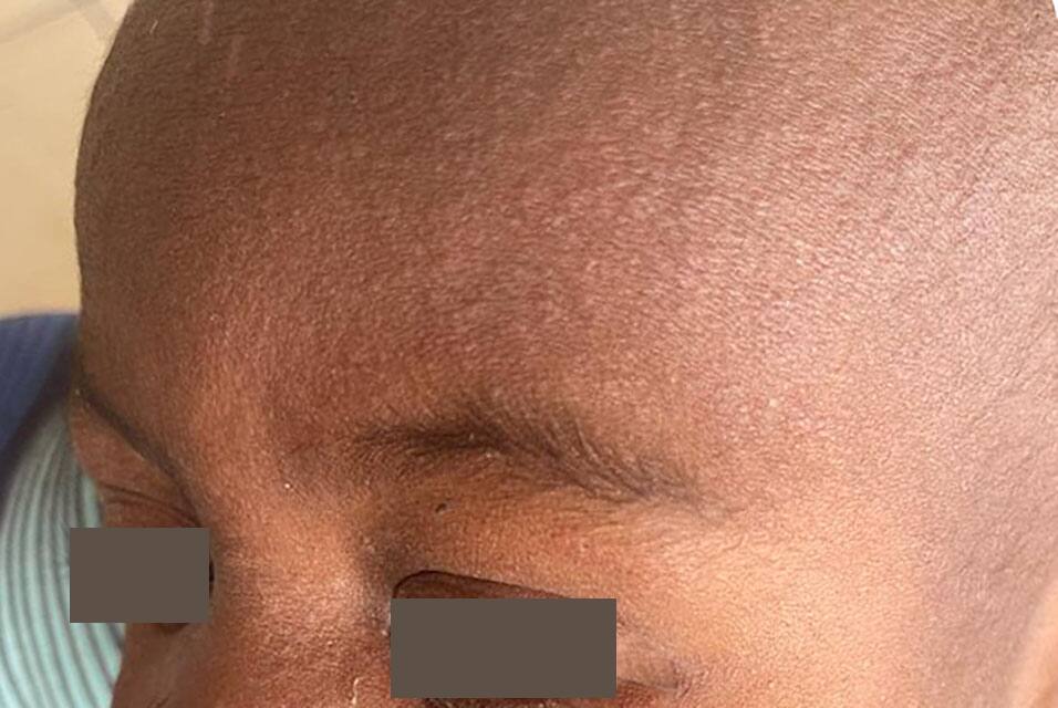 Close-up view of a measles rash on skin